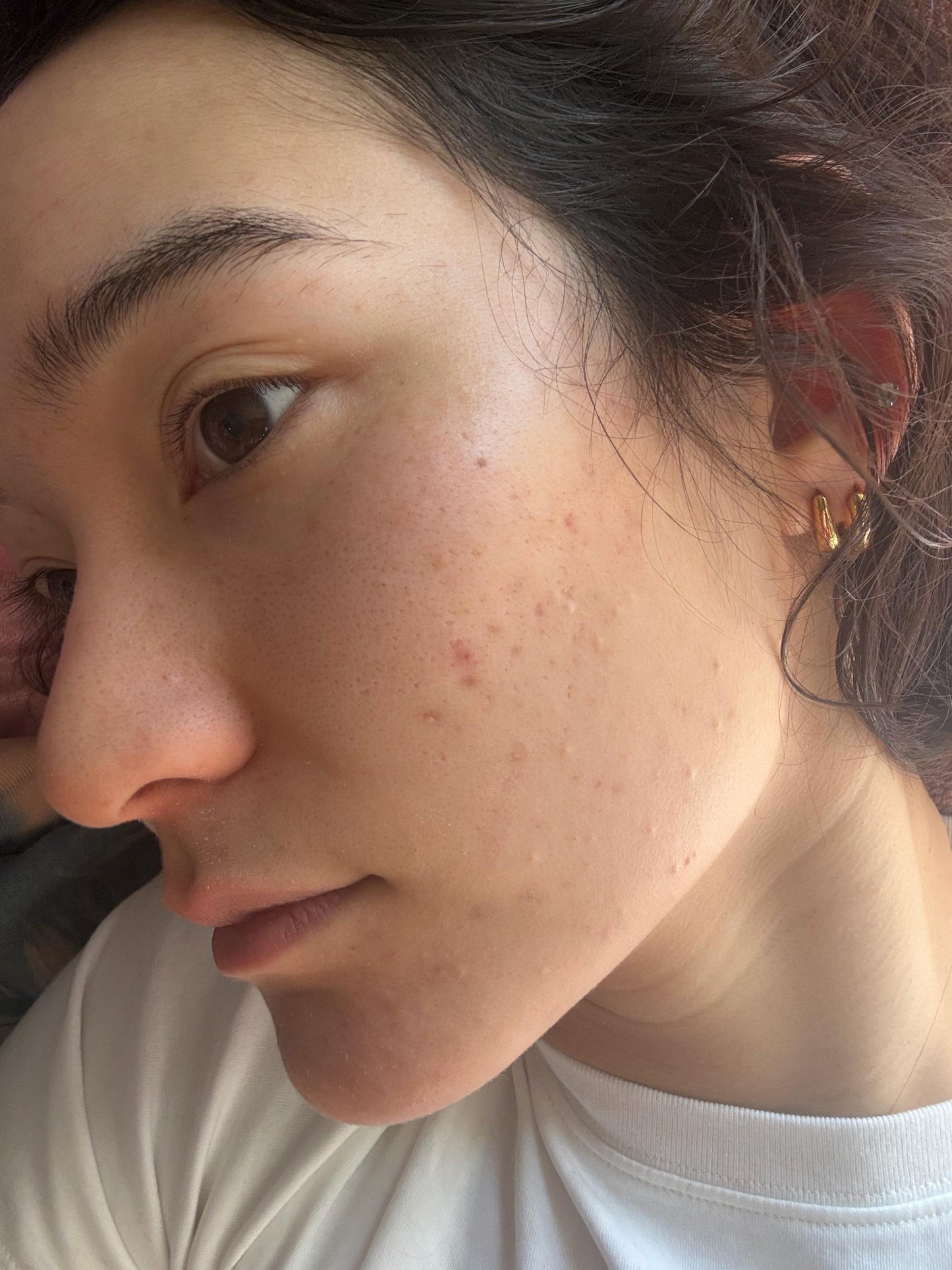 BREAK OUT PRONE SKIN ROUTINE